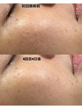 アットウィル 志木店(at will)/☆マイクロニードルピーリング☆