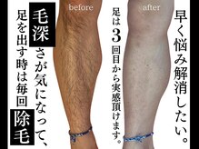 ジェントルメンズグロー(Gentlemen’s Glow)/【足・腕・脇脱毛】