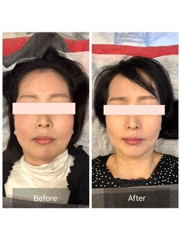 プライミー(PRIMY)/面長調節