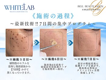 《韓国美容専門店》BELL BEAUTY SALON &nbsp;&nbsp;小顔/毛穴洗浄/シミ/痩身の写真/【7日後に剥がれる!?】超最新ホワイトラボの"剥がすシミケア"に予約殺到★最短×効果でシミ改善したい方に!