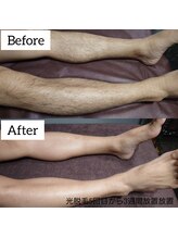 ジュゴン(Dugong)/足脱毛（Before＆After）