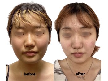 けいのき鍼灸整骨院/美容鍼3ヵ月8回の効果！美容鍼灸