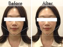 ハリラウンジ 梅田店(Hari Lounge)/美容鍼専門サロン Hari Lounge