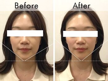 ハリラウンジ 梅田店(Hari Lounge)/美容鍼専門サロン Hari Lounge