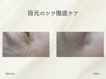 ホリスティックサロン ヘルバ(Holistic salon Herba)/目のシワケア　施術変化