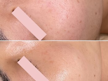 エイプリルフールズ(April fools)/頬の毛穴ケアが小さく！