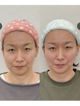 小顔22 ボルティ 本店(Bolty)/Boltyお客様