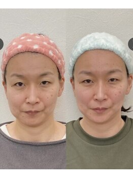 小顔22 ボルティ 本店(Bolty)/Boltyお客様