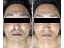 ホッコリ 段原店(HOKKORI)/人気No.1！ヒゲ脱毛♪