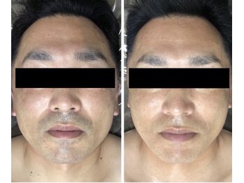 ホッコリ 段原店(HOKKORI)/人気No.1！ヒゲ脱毛♪