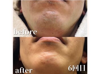 サロン ルーシュ(salon ruche)/脱毛(ひげ)