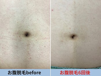 ミスターアンクール 鹿児島(Mr.uncoeur)/へそ周り脱毛6回後