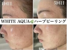 ホワイトアクア 四日市店(WHITE AQUA)/三重ハーブピーリング