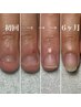 【女性深爪矯正】まるで自爪?深爪の見た目を改善しながら自爪を伸ばします