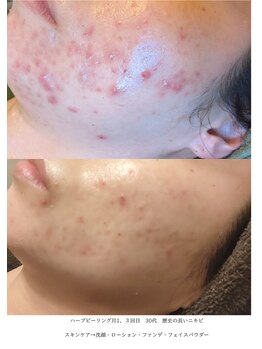 デコアイ(Deco eye)/30代女性 歴史の長いニキビケア