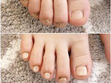 グラシナ 鳥丸店/爪が伸びれば痛みも変わる