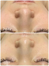 ラグ(LUXU)/超音波毛穴洗浄