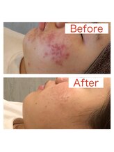 ジョア(joie)/美容鍼で肌荒れケア