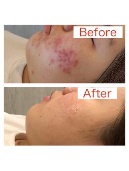 ジョア(joie)/美容鍼で肌荒れケア