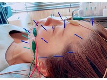 てて整骨院 針ヶ谷店/当院おすすめメニュー[美容鍼]