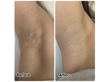 べっぴん脱毛×なないろ美人 鈴鹿店の雰囲気(【脇脱毛】3ヶ月/6回施術)