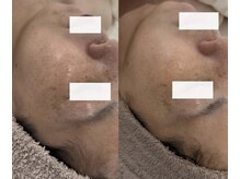 シミケア大人気メニュー！1回満足☆個々に合わせた施術が得意♪