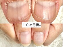 グラシナ なんば店/深爪/自爪育成/フィルイン