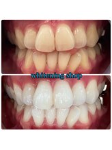 ホワイトニングショップ 越谷店/