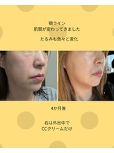 グリーンドロップ(Green Drop)/ホームケアのみ3ヶ月の変化です