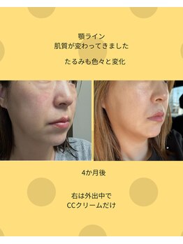グリーンドロップ(Green Drop)/ホームケアのみ3ヶ月の変化です