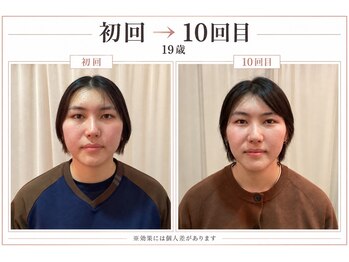 小顔美肌ファクトリー 梅田院/初回から10回目の変化