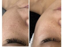 サロン ド ビューティージュエル(salon de beauty JEWEL)/プラズマニア&光フェイシャル2回