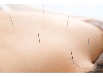 長者町ビオス整骨院/鍼