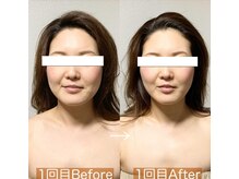 【テラボーラー】衰えた表情筋を鍛えてリフトアップ♪