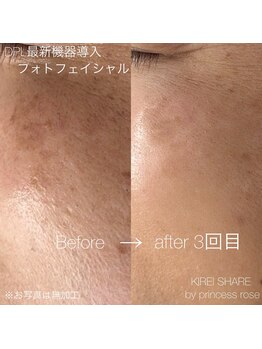 KIREI SHARE by princess rose マツエク/まつげパーマ/眉毛/メンズ/脱毛/フェイシャル/