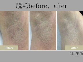 リル シャイン(Rill SHINE)/男性脇脱毛!