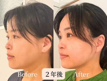 ロシュニ/40代 お悩み:たるみ/首肩こり