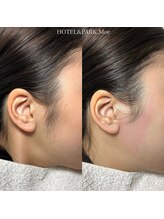 ホテルアンドパーク(HOTEL&PARK.)/もみあげワックス脱毛/Moe施術