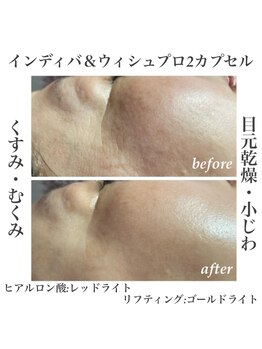 プラチナローズ(Platinum Rose)/インディバ＆ウィッシュプロ