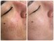 シェミー(CHEZ MEE)の写真/【夏の紫外線ダメージ撃退】徹底的なシミ・しわ改善ケア！毛穴洗浄との相乗効果で内側から輝く透明美肌へ♪