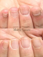 マリーロール 梅田店(Marie Laure)/自爪育成/深爪矯正/ネイルケア