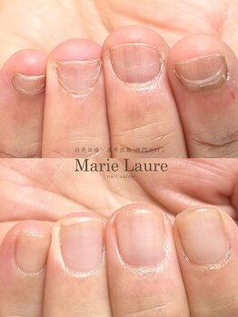 マリーロール 梅田店(Marie Laure)/自爪育成/深爪矯正/ネイルケア