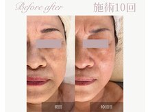 パルタージュ(Partage)/透明肌／白玉水光肌フェイシャル