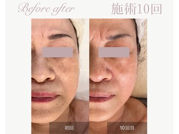 パルタージュ(Partage)/透明肌／白玉水光肌フェイシャル