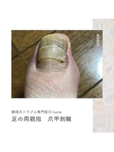 オツメ 静岡(O-tume)/爪甲鉤弯