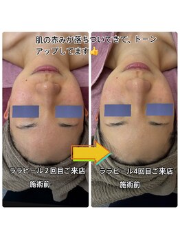 リエル(Liel)/ララピールは肌の赤みにも◎♪