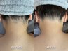New【うなじW脱毛】シュガーリング×光〈もみあげ/襟足/耳裏含む〉8800円