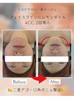 美ネージュの写真/ 【金沢/小顔】レモンボトル進化版レッドショット導入！圧倒的小顔＆リフトアップで二重アゴ解消

