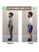 姿勢矯正院/子供の姿勢改善例