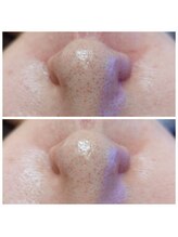 ラ ドウ 名古屋黒川店(la.dow)/気になる小鼻の黒ずみ